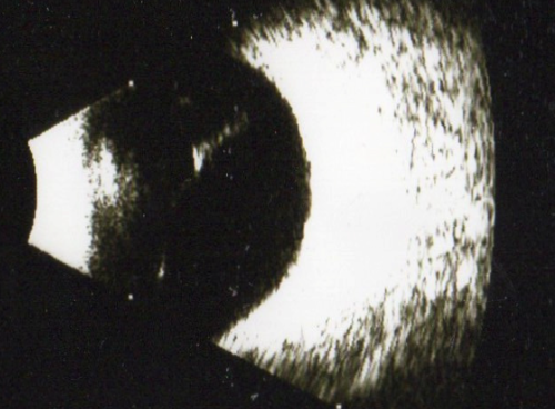 비문증 손상 사진