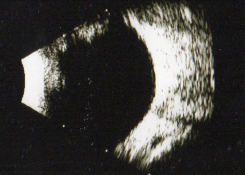 브로멜라인 효소 섭취후 비문증 사라진 초음파 사진