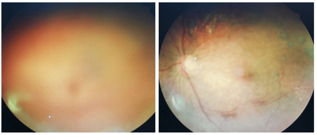 안구 출혈로 인한 환자 비문증 치료 사진