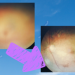 비문증 집에서 없애기 썸네일