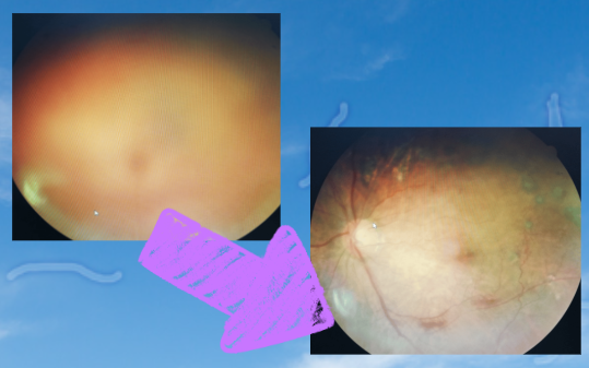 비문증 치료를 위한 최신 연구 결과와 브로멜라인 효소의 극적인 실험 결과