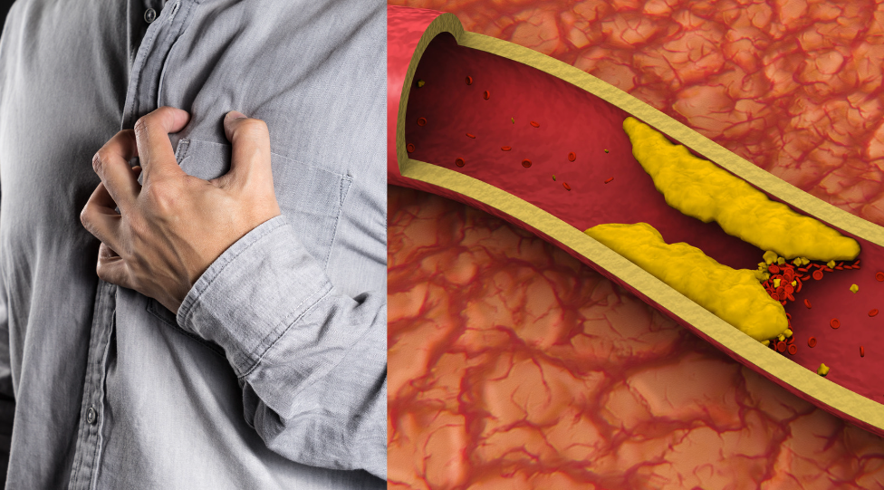 고혈압 동맥경화와 심근경색